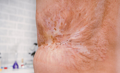 Man with a severe burn all over his body. Close up.