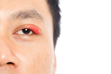 stye on the people eye. bacterial infection in the eyelid.