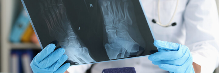 Doctor traumatologist examines x-ray of feet closeup