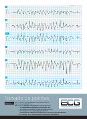 During an episode of torsade de pointes, the polarity of the QRS complex is reversed around the isoelectric line of the ECG, but some leads are more consistent in polarity.