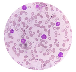 Photomicrograph of Acute Myeloblastic Leukemia (AML), a cancer of white blood cell