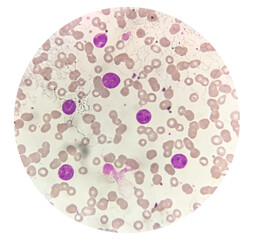 Photomicrograph of Acute Myeloblastic Leukemia (AML), a cancer of white blood cell
