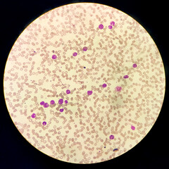 Microscopic image showing Chronic myeloid leukaemia (CML) is a type of cancer, all stage of...