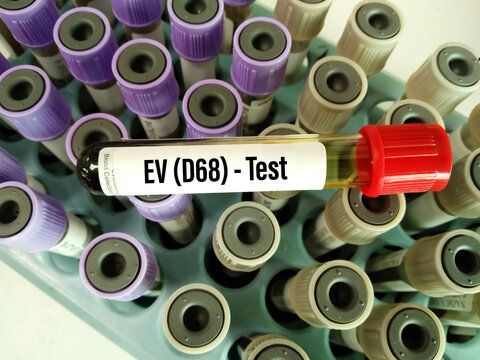 Blood sample for Enterovirus D68 test. It's a member of the Picornaviridae family, an enterovirus. First isolated in California in 1962 