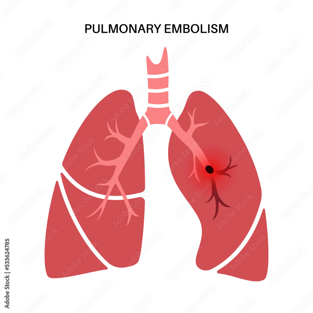 Wall mural Pulmonary embolism disease