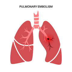 Pulmonary embolism disease - obrazy, fototapety, plakaty