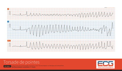 Torsade de pointes refers to the pleomorphic ventricular tachycardia that occurs in the background of long QT interval, and the polarity of QRS wave twists around the equipotential line. - obrazy, fototapety, plakaty