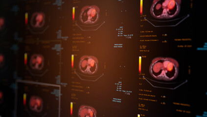 Selective focus of PET-CT imaging showing avid FDG uptake inside myocardium.