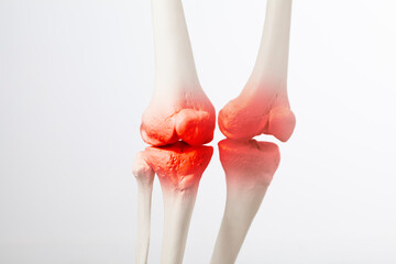 Knee meniscus inflamed, human leg, medically accurate representation of an arthritic knee joint - obrazy, fototapety, plakaty