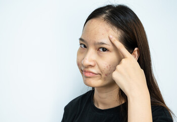 Asian woman pointing to acne problems inflamed on her forehead.
