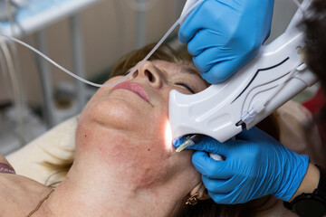 Fototapeta premium Correction of the second chin by injections of carbon dioxide by a cosmetologist woman aged
