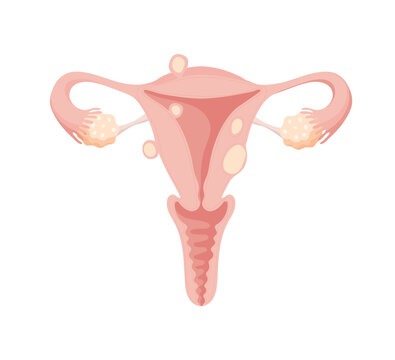 Female uterus with different types of fibroids, treatment of benign tumors by modern medicine. Flat isolated vector anatomical illustration, female health care, gynecology.