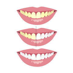 Compare before and after yellow and whitening tooth procedure by dentist, illustration on white background