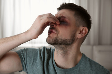 Man with bruise on face at home. Domestic violence victim