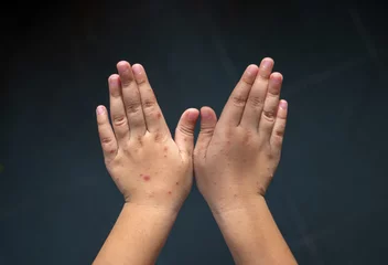 Rash on the hands of the Hand foot and mouth disease. Hand-foot-and-mouth disease is most commonly caused by a coxsackievirus and Enterovirus. © stpadcharin