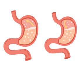 Human stomach set. Gastroesophageal reflux disease concept. Unhealthy stomach concept. Heartburn, illness, discomfort, pain. Flat vector illustration isolated on white