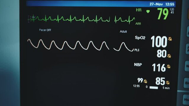 Black screen with two wavy lines running. Monitor with patient's vital signs of an operated patient. Close up.