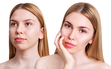 Young woman before and after acne treatment and make-up.