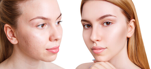 Young woman before and after acne treatment and make-up.