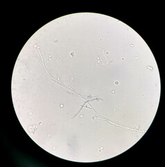 Budding yeast cells with pseudohyphae in urine sample.