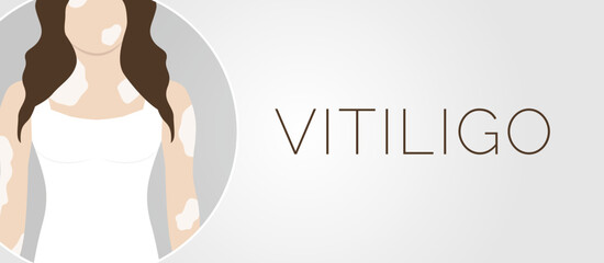 Vitiligo Skin Condition Illustration Banner Background