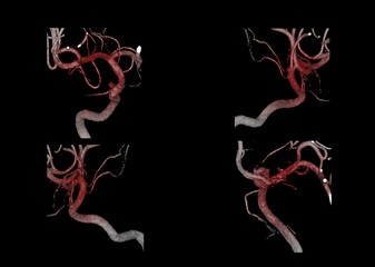 Cerebral angiography  3D .