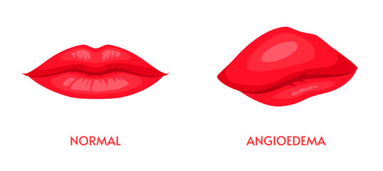 Angioedema or edema of lips, allergic swelling of lower layer of face skin or body tissue. Comparison of vector swollen and healthy upper lips or mouth, disease of lymphatic system, health care themes