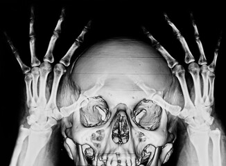 x-ray skull with bones, for halloween or medicine