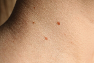 Fototapeta premium Closeup view of woman's body with birthmarks