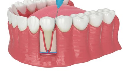 Human jaw with intraligamentary anesthesia procedure 