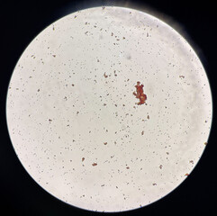 Fototapeta Red blood cell agglutination Crossmatching Incompatible donor. obraz