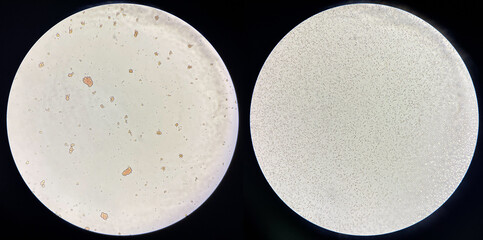 Left Red blood cell agglutination Crossmatching Incompatible donor.right Red blood cell non...