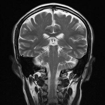 normal T1 coronal plane  brain Magnetic resonance imaging (MRI)