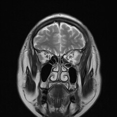 normal T1 coronal plane  brain Magnetic resonance imaging (MRI)