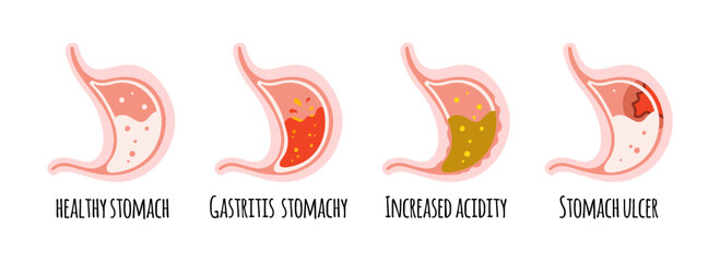 The stomach of a healthy person, with ulcers, gastritis, acidity. Gastroenterology. Vector illustration in a flat style.