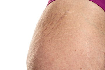 Female hip with stretch marks  sensitive problematic skin on a white
