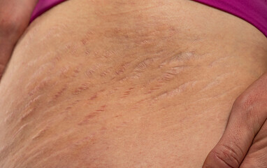 Close-up of a female thigh with white and dark stretch marks from a sharp weight loss or weight gain isolated on a white background
