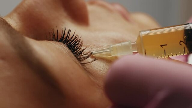 Blood plasma injections in the eye area.
