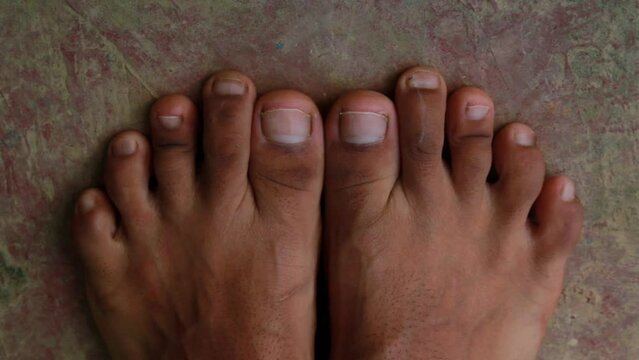 Male Foot with second toe longer than a big toe. LaMay toe, Morton's foot and Greek foot.