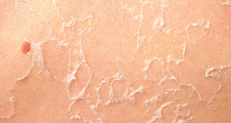 Fototapeta premium Sunburn, close-up of human skin. Flaky skin from allergies, peeling or eczema. Dry skin in need of treatment and hydration.