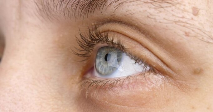 female eye diagnosed with keratoconus corneal thinning High quality 4k footage