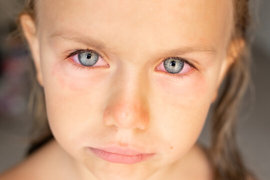 Close Up. Sad Cry Little Girl Child Red Eyes With Conjunctivitis, Viral On Eye. Allergy To Pollen. Irritated Red Bloodshot Eye, Red And Irritated Human Eye