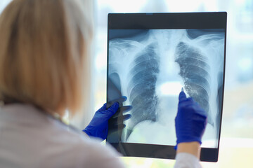 Woman doctor holding x-ray of lungs in hospital