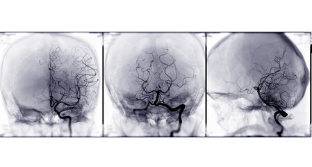 Collection of Cerebral angiography 3 - obrazy, fototapety, plakaty