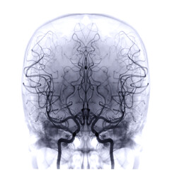 Cerebral angiography