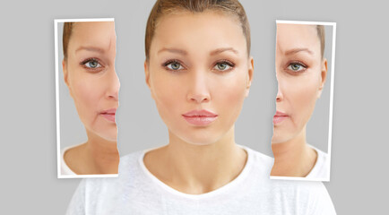 Effects of ageing,Frownscowl lines ,Nasolabial folds,Neck ,Under eye circles,neck lines. Plastic Surgery Results