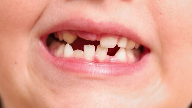 Close up video shot of unrecognizable child toothless mouth with milk teeth, compressing and opening jaw. Dentist and hygiene care, health treatment for right bite. Malocclusion, overbite problem