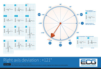 When the electrical axis deviates to the right, the maximum QRS vector is located in the lower right quadrant, which can be interpreted in combination with the QRS wave characteristics of limb leads.