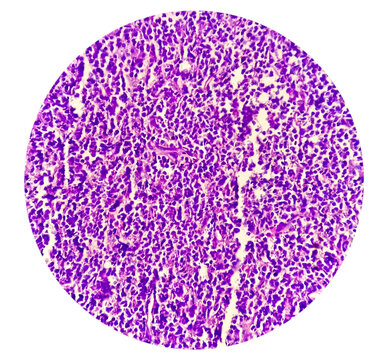 Cervical lymph node cytology: Lymphoproliferative disorder favor Non-Hodgkin's lymphoma. Smear show cellular material of monotonous population of atypical lymphocytes.