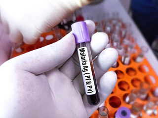 Blood test sample for Malaria Ag (Pf,Pv) test to diagnose malaria caused by a parasite